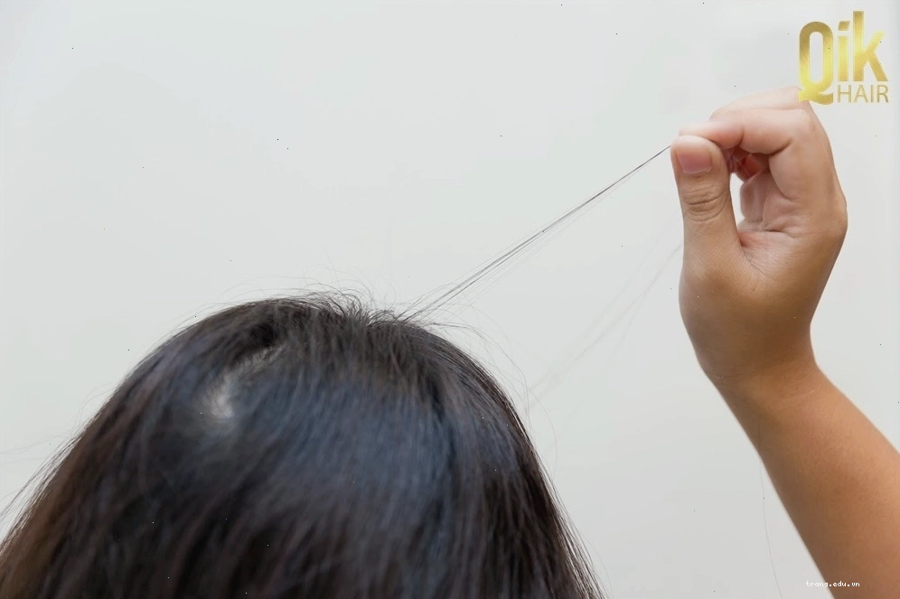Hội chứng nghiện giật tóc gây tổn thương cho nang tóc và da đầu